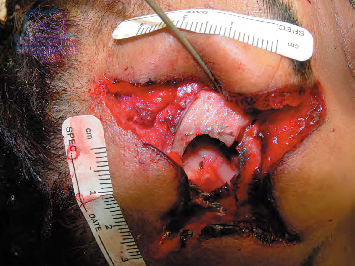 Stellate-shaped contact wound of the forehead